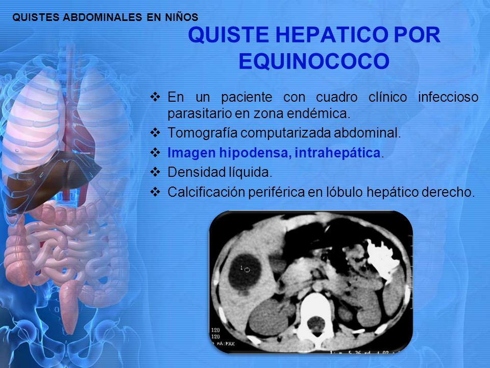 Sintomas quiste hepatico